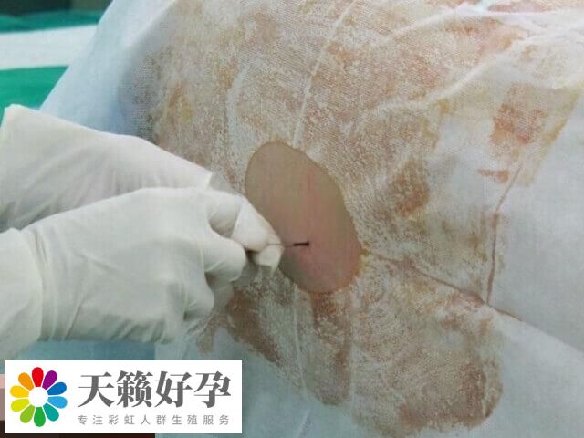 淺析試管嬰兒為什么還要做宮腔鏡，評估子宮環境為其一